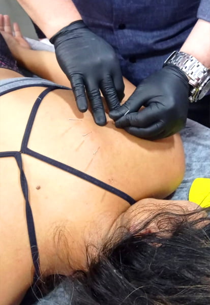 Dry Needling- Agulhamento a seco​